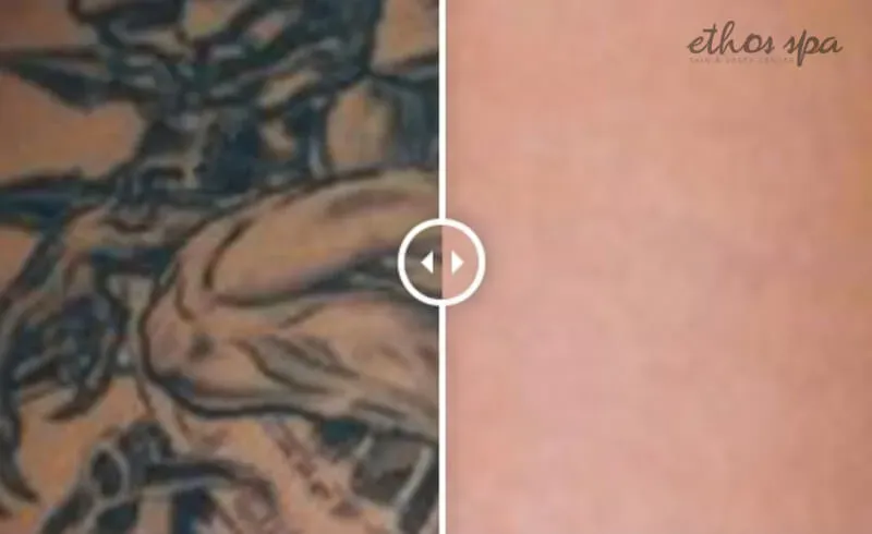 before and after of tattoo removal