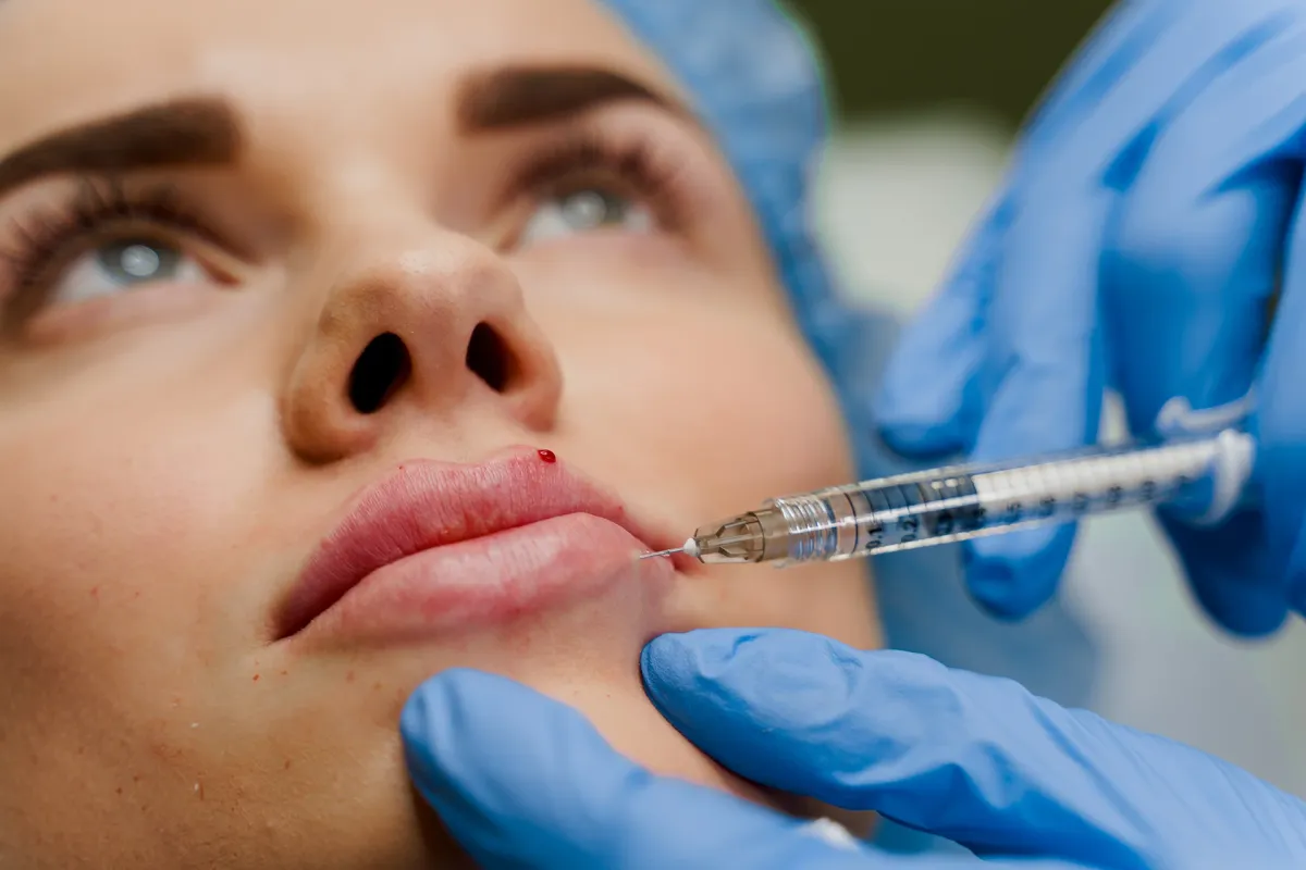 Lip Filler Complications: Symptoms of Lip Necrosis After Filler Injections