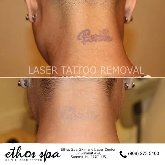 How Can I Remove My Permanent Tattoo Without Laser?