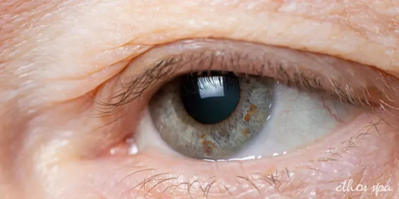 Close-up of a drooping upper eyelid