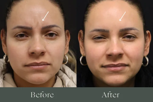 Botox before and after results 1