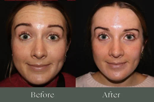 Botox before and after results 2