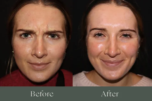 Botox before and after results 3