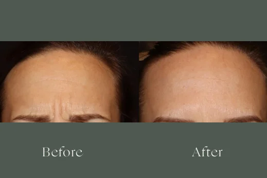 Botox before and after results 4