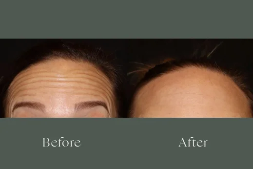 Botox before and after results 5