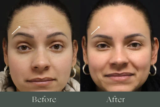 Botox before and after results 6