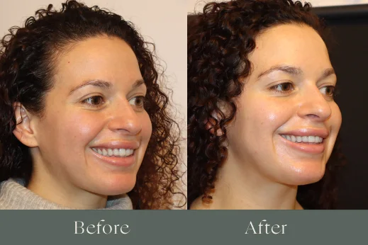 Botox before and after results 7