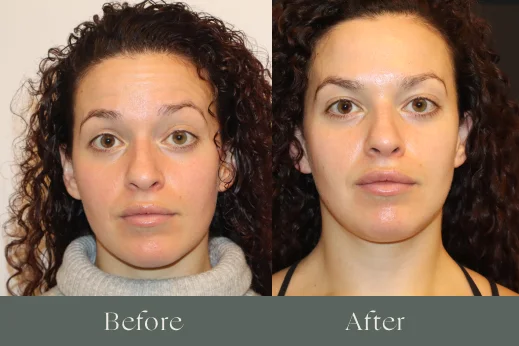 Botox before and after results 8