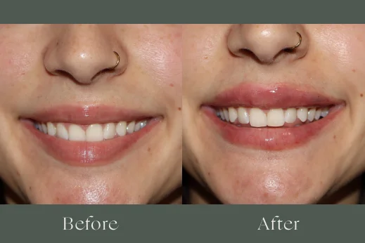 Dermal filler before and after results 10
