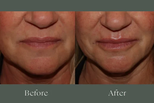 Dermal filler before and after results 13