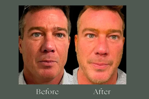 Dermal filler before and after results 16