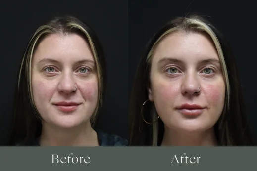 Dermal filler before and after results 2