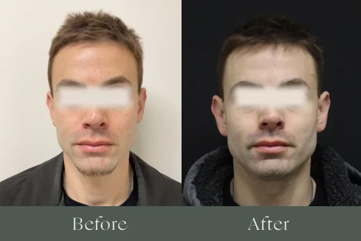 Dermal filler before and after results 7