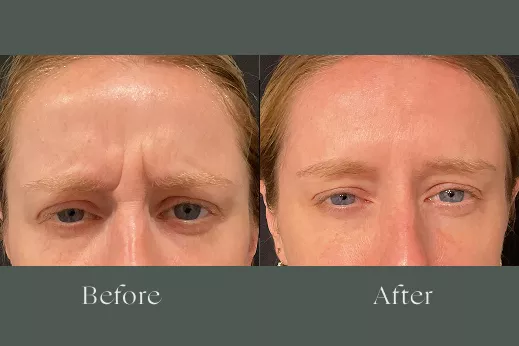 Botox before and after results 9
