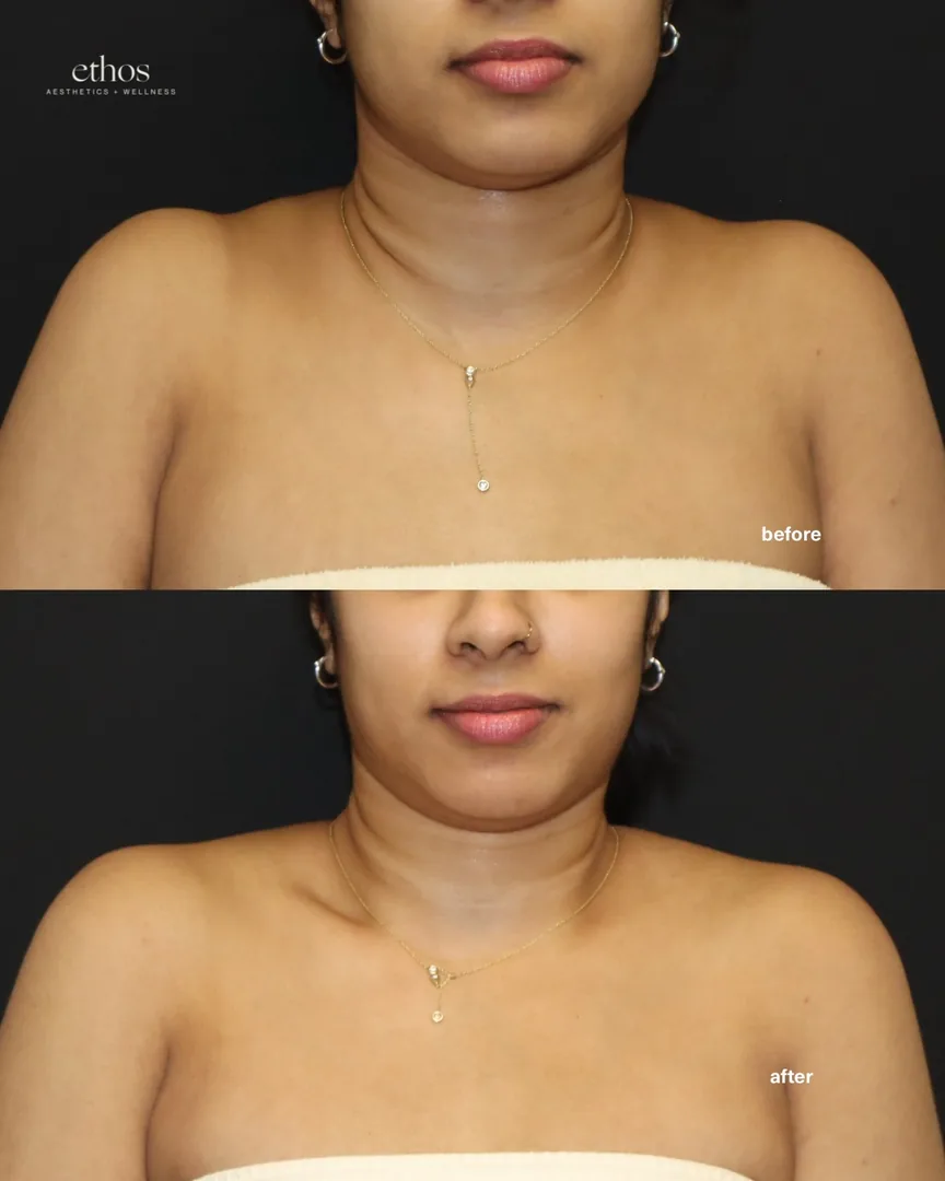 Botox before and after results 18
