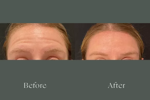 Botox before and after results 11