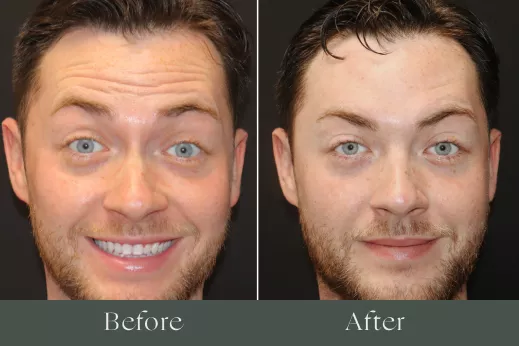 Botox before and after results 12