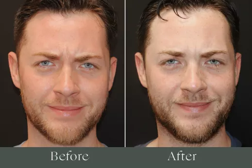 Botox before and after results 13