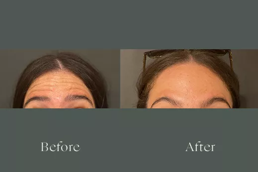 Botox before and after results 14