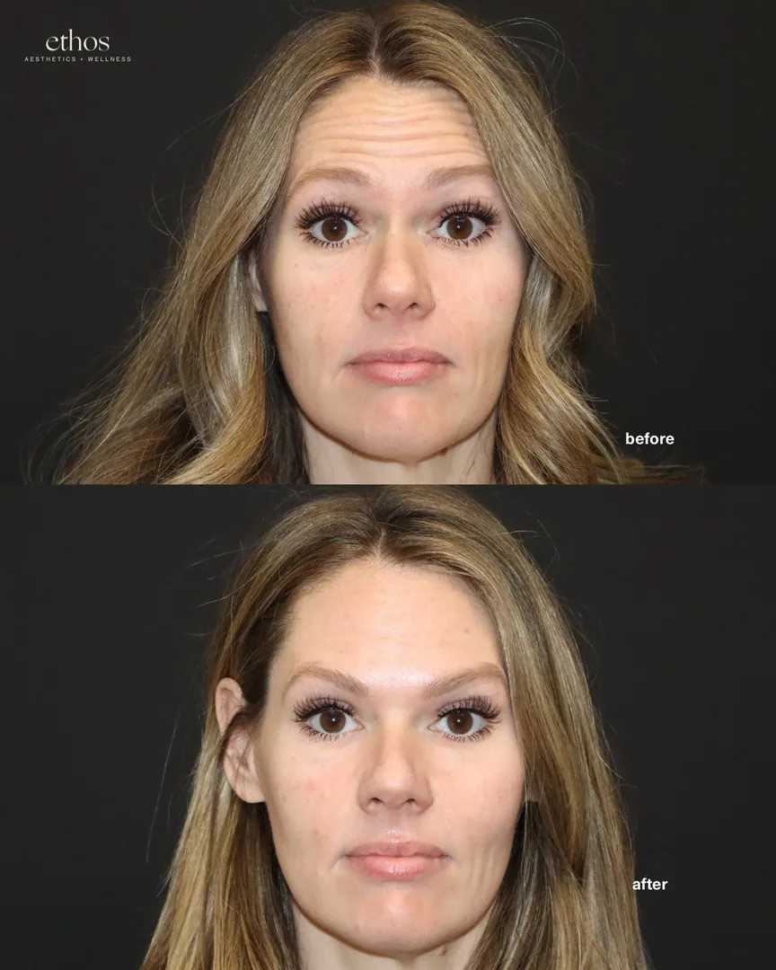 Botox before and after results 16