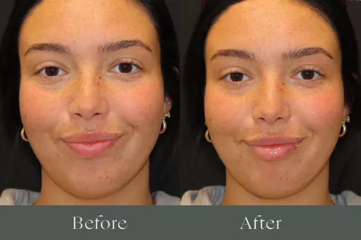 Lip filler before and after results 17