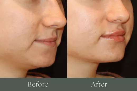 Lip filler before and after results 20