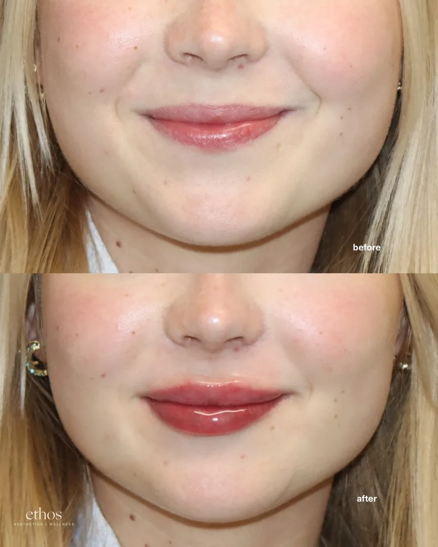 Lip filler before and after results 25