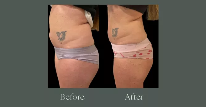 Emsculpt before and after results 2