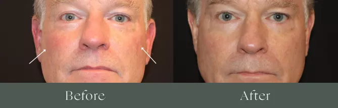 Laser hair removal before and after results 7