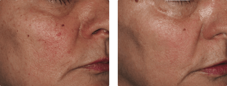 M22 laser treatment before and after results 2