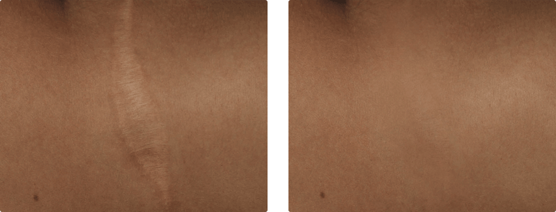 M22 laser treatment before and after results 3