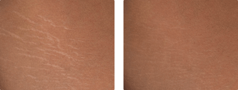 M22 laser treatment before and after results 4