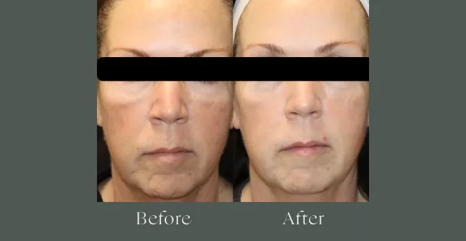 Microneedling before and after results 1