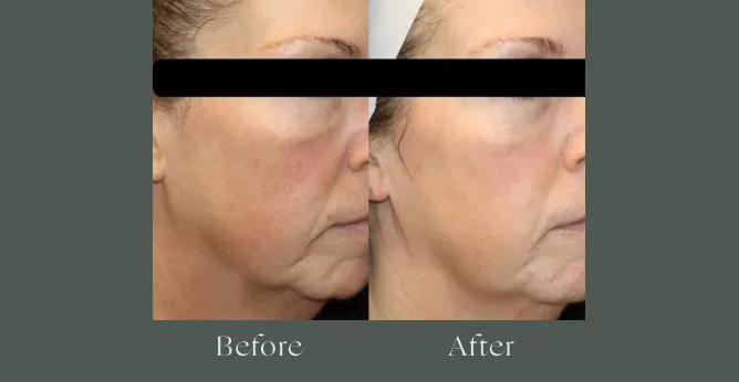 Microneedling before and after results 2
