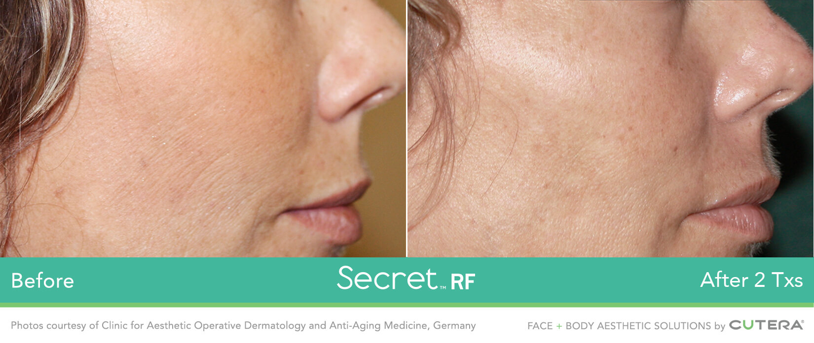 RF microneedling before and after results 1