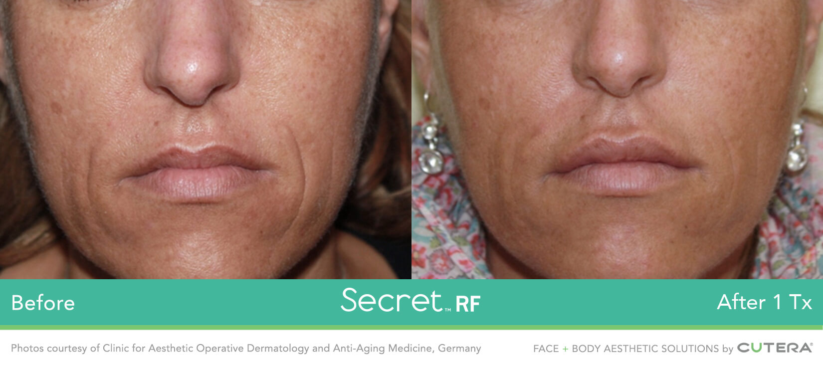 RF microneedling before and after results 2