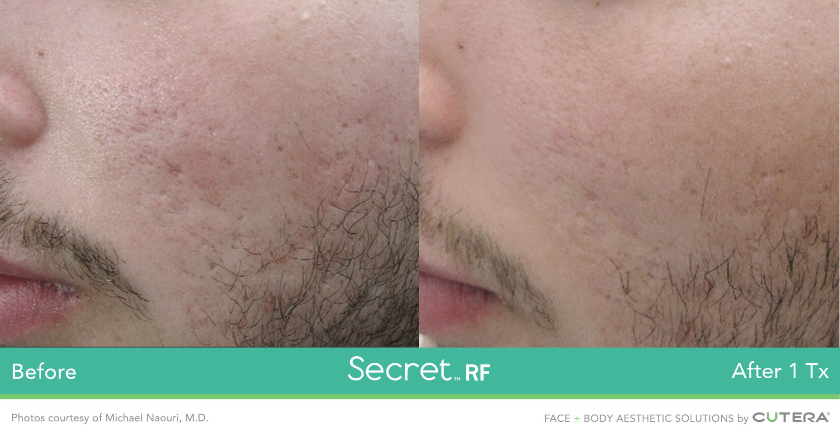 RF microneedling before and after results 3