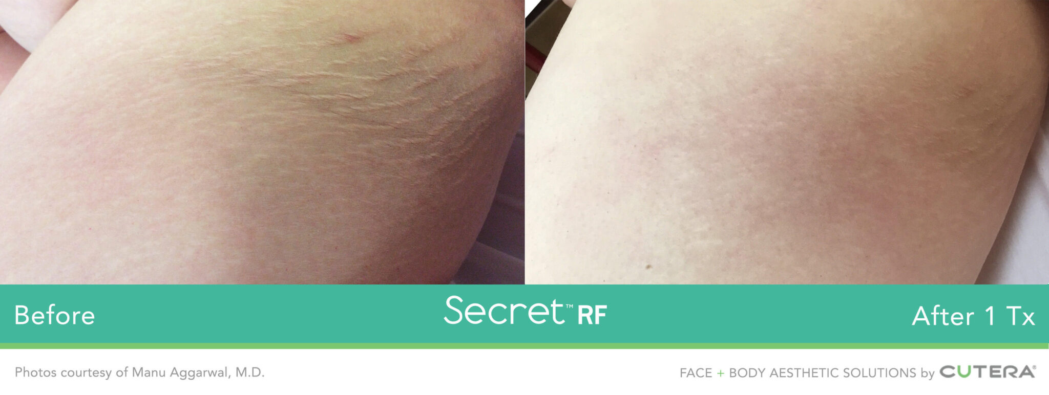 RF microneedling before and after results 4