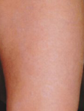 Tattoo after removal