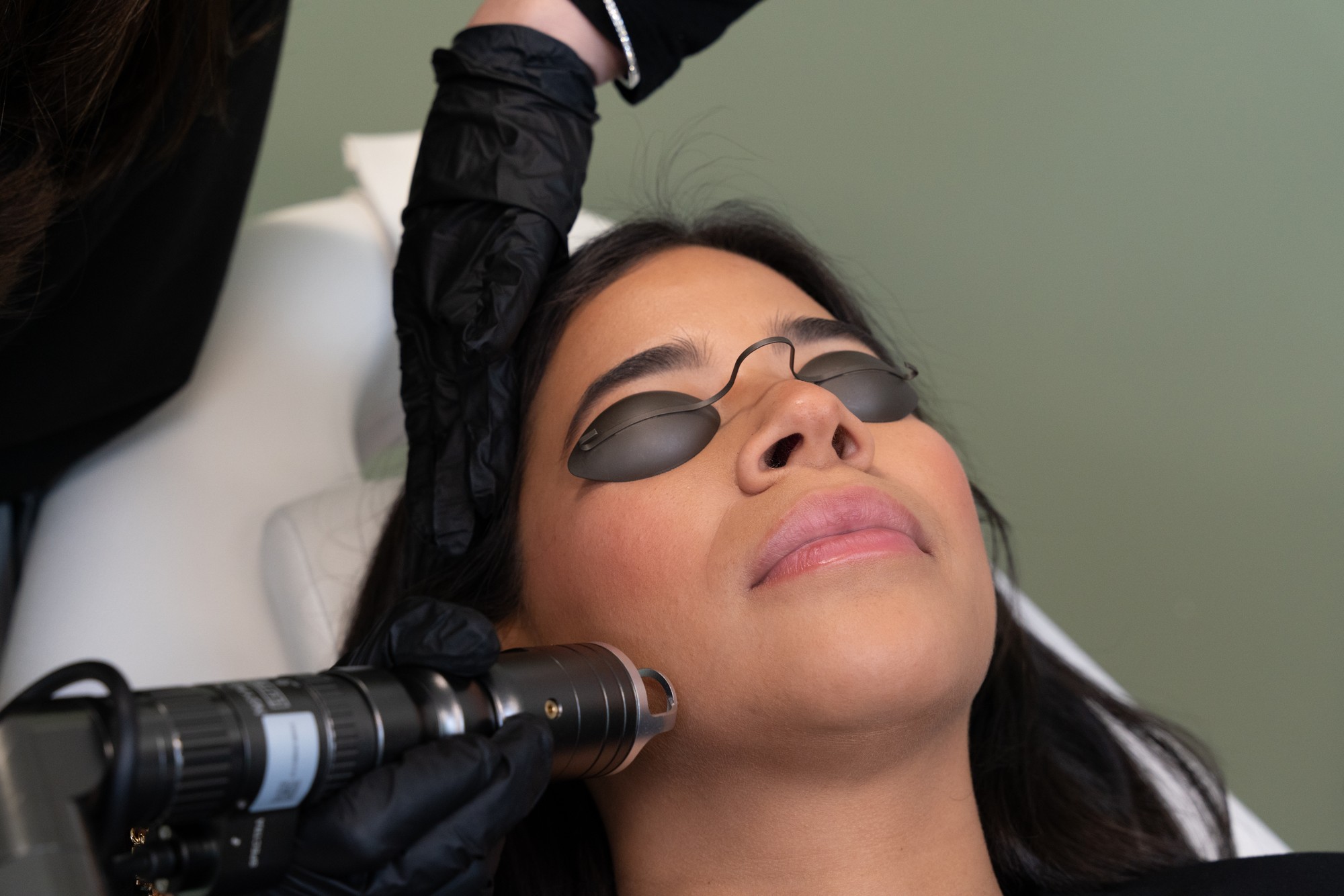M22 IPL photofacial treatment