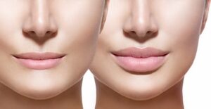 38253537 - before and after lip filler injections. lips closeup over white