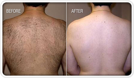 Laser Hair Removal - Back | Before and After