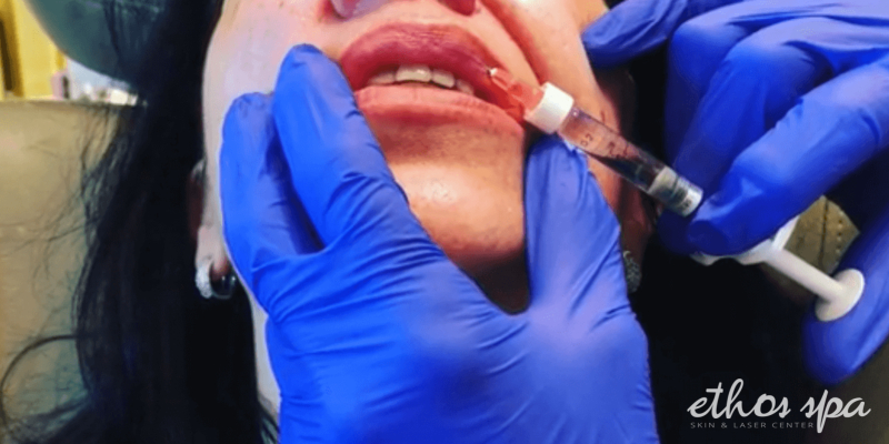Woman receiving botox in her lips