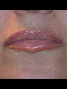before and after lips juvederm after