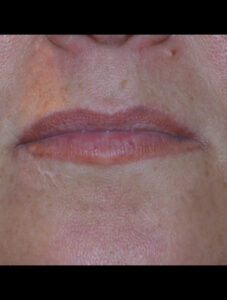 before and after lips juvederm before