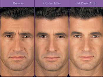 botox before and after male