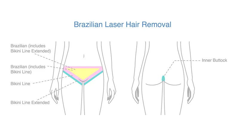 Brazilian laser hair removal areas