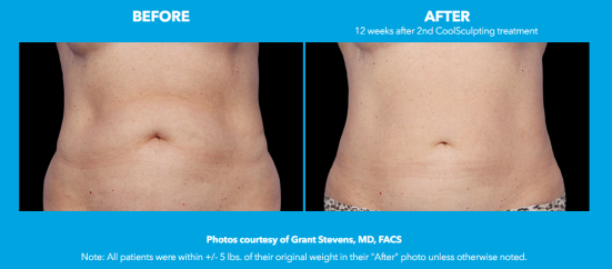 3 things you need to know about coolsculpting