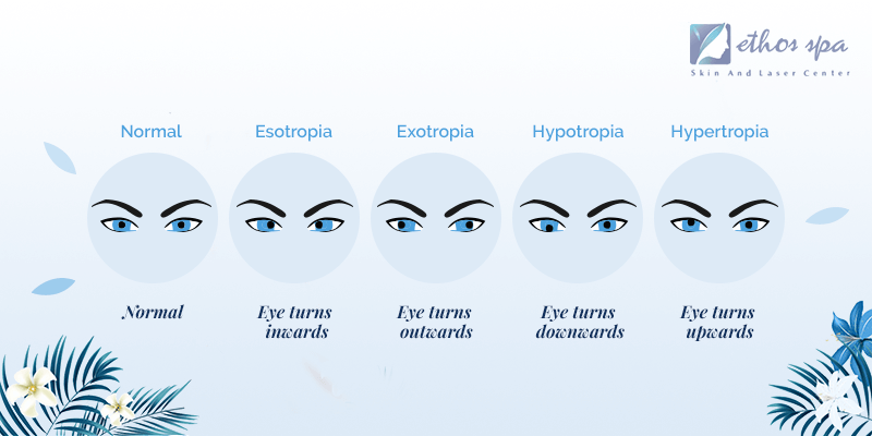 Botox Medical Use - Eye Disorders