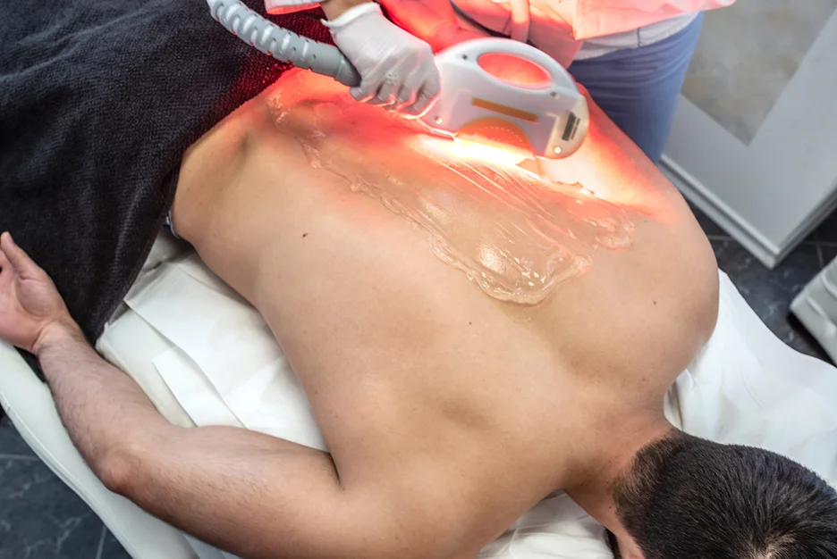 laser hair removal treatment on man's back